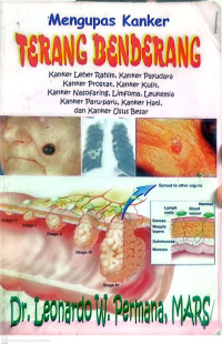 Image of Mengupas Kanker Terang Benderang